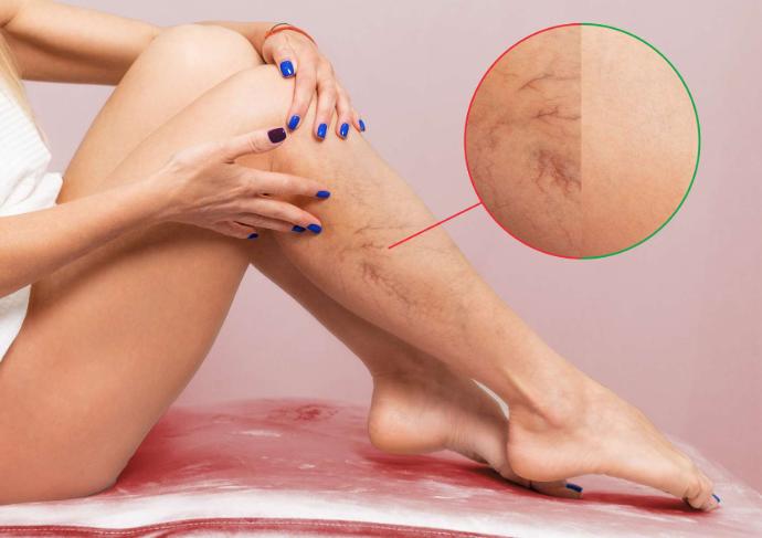 Jambes de femme avec varices et rond à côté qui les montrent en gros plan