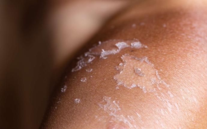 Peau bronzée qui pèle