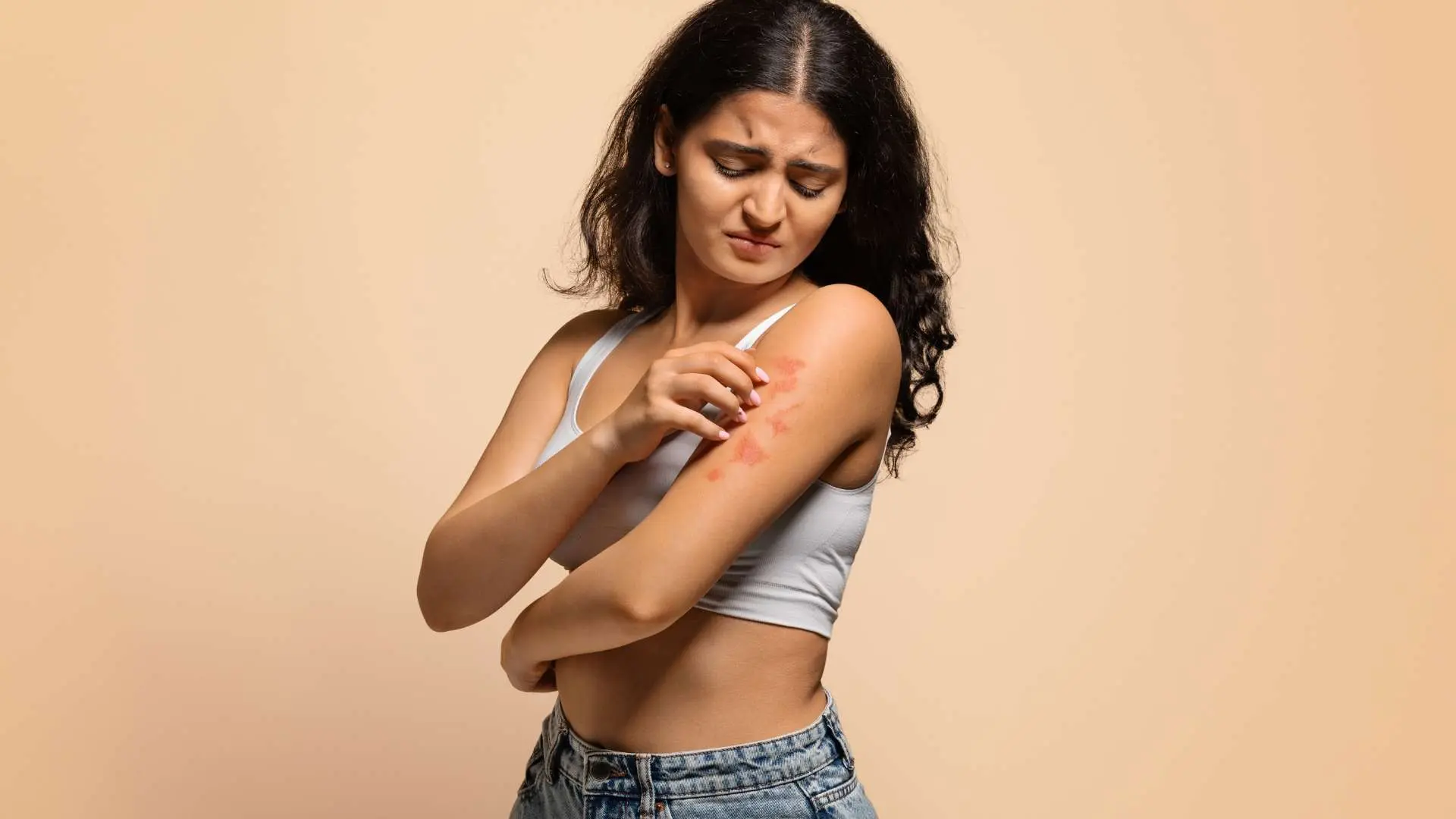 Jeune femme brune qui se gratte des plaques d'eczéma sur le bras 